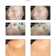 Hot Cold Hammer Skin Cool Lifting Cryotherapy