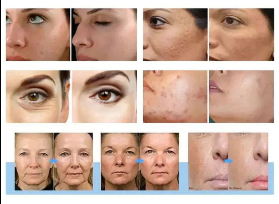 12-in-1 Aqua Peeling Hydro Facial Machine | Skin Cleansing, Bubble Oxygen & Lifting