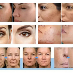 12-in-1 Aqua Peeling Hydro Facial Machine | Skin Cleansing, Bubble Oxygen & Lifting